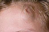 Haematoma on forehead following an accident