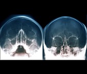 Paranasal sinuses, head X-rays