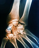 Non-healed scaphoid fracture, X-ray