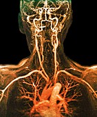 Chest, neck and head arteries, MRI angiogram