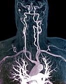 Cervical artery dissection, MRI angiogram