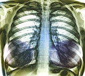 Heart and lungs, chest X-ray