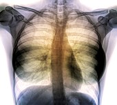 Heart and lungs, chest X-ray