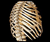 Rib fractures, 3D CT scan