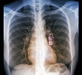 Cardiac monitoring device, chest X-ray