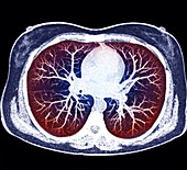 Heart and lungs, CT scan