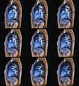 Heart-lung profiles, MRI angiograms