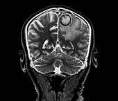 Secondary brain cancer, MRI scan