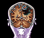 Secondary brain cancer, MRI scan