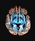 Creutzfeldt-Jakob disease, MRI scan