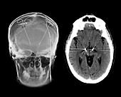 Parkinson's disease brain stimulation electrodes