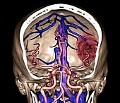 Stroke and intracerebral haemorrhage, 3D CT angiogram