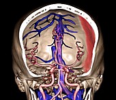 Subdural haematoma, 3D CT angiogram