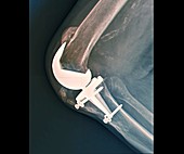 Total knee replacement, X-ray