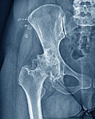 Osteoarthritis of the hip, X-ray