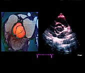 Aortic valve congenital deformity, CT and ultrasound scans