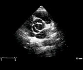 Aortic valve congenital deformity, cardiac ultrasound scan