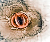 Aortic valve replacement, 3D CT scan