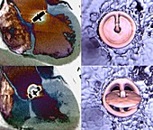 Aortic valve replacement, 2D and 3D CT scans