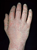 Eczema on the hand