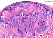 Squamous cell carcinoma of the tongue, light micrograph