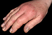 Cellulitis of the hand