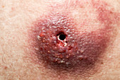 Infected sebaceous cyst