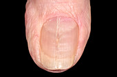 Ridged finger nail in eczema