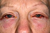 Viral conjunctivitis