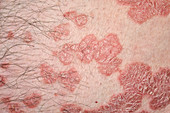 Plaque psoriasis