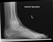 Osteoarthritis of the ankle, X-ray