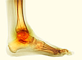 Osteoarthritis of the ankle, X-ray