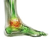 Osteoarthritis of the ankle, X-ray
