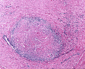 Tuberculosis granuloma, light micrograph
