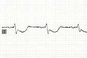 ECG trace for a heart attack, electrode III