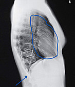 Lateral Chest X-Ray Showing Heart