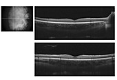 Spectral Domain optical coherence tomography of human fovea