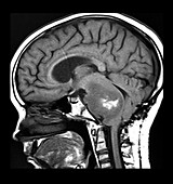 MRI Brainstem Glioma