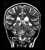 MRI Brainstem Glioma