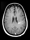 Cerebral Developmental Venous Anomaly (DVA)