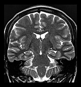 MRI Incomplete Inversion of Hippocampus