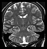 MRI Incomplete Inversion of Hippocampus