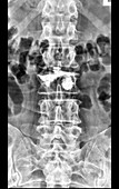 Vertebroplasty L3 on X-Ray