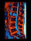 Enhanced MRI Large L5 S1 Disc Herniation