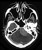 MRI Large Acoustic Schwannoma (Vestibular Schwannoma)