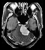 MRI Large Acoustic Schwannoma (Vestibular Schwannoma)