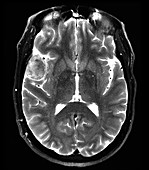 Pterional Meningioma on MRI