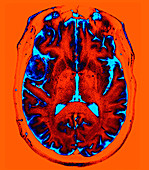 Enhanced Pterional Meningioma on MRI