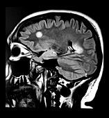 MRI Balo's Concentric Sclerosis