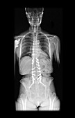 X-ray of Spinal Instrumentation